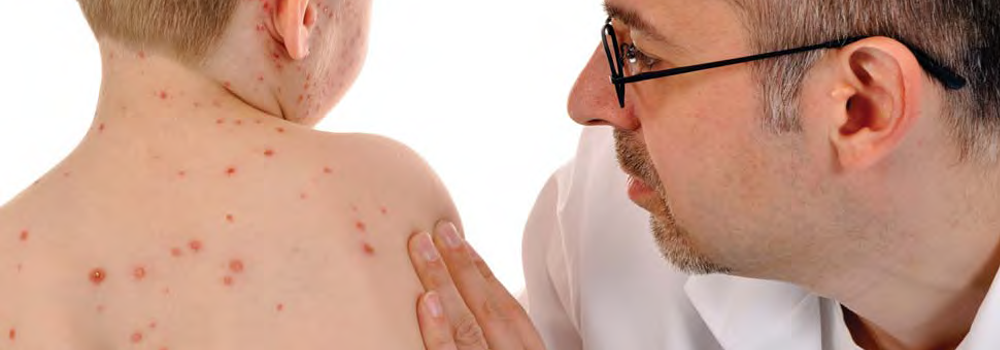 Chickenpox and measles